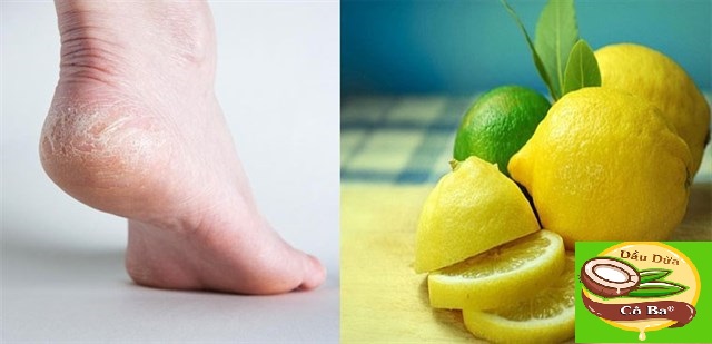 Cách chữa gót chân bằng chanh